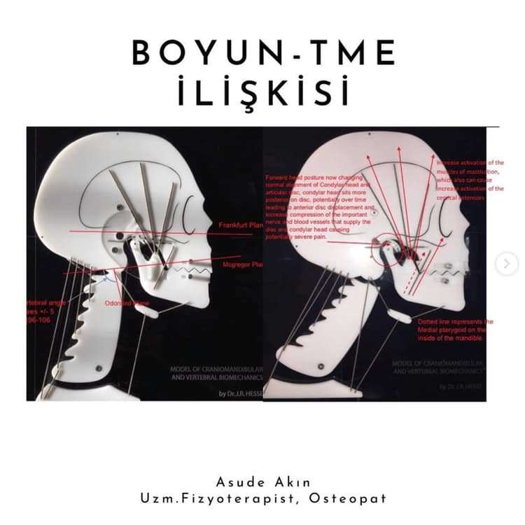 Boyun - TME İlişkisi
